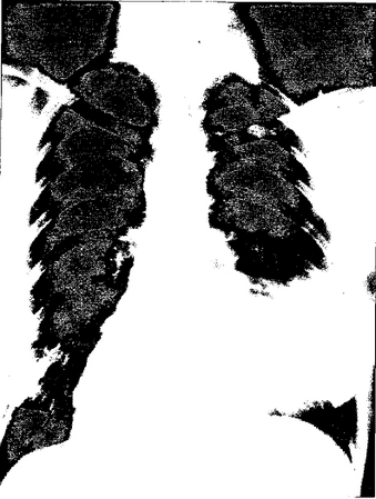 Terbium is often used in X-ray machines. This X-ray shows pneumonia in the lower lobe of the patient's left lung.