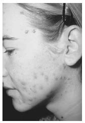 A female with untreated acne on her face. Several prescription and nonprescription drugs are used to effectively treat acne.