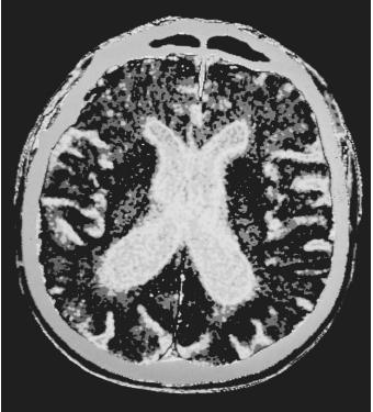 A CAT scan of a human brain with Parkinson's Disease, with visible atrophy.