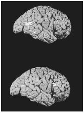Two positron-emission tomography (PET) scans showing the brain of a depressed person (top) and a healthy person (bottom).